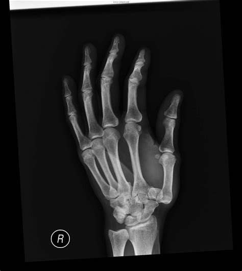 Isolated First Carpometacarpal Joint Dislocation Managed With Closed