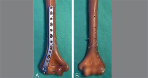 SciELO Brazil A NEW ANATOMICAL PLATE FOR EXTRA ARTICULAR DISTAL