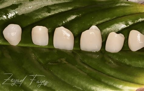 6 anterior zircon crowns - MyZerodonto