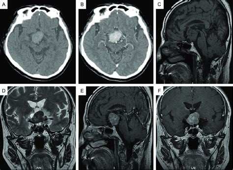 A Ct Showed A Well Defined Homogenous Slightly Hyperdense