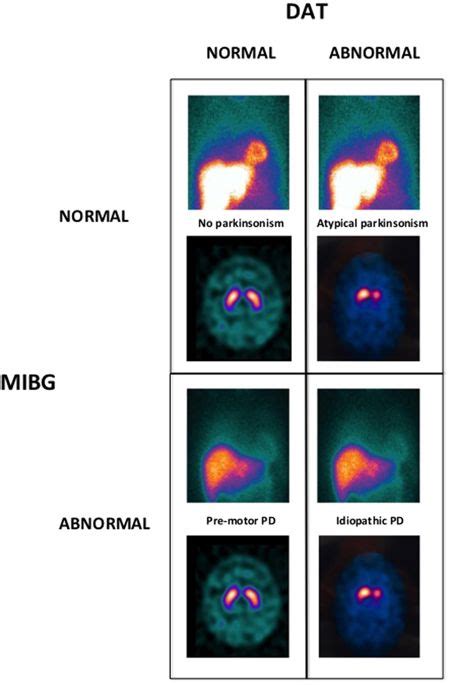 Optimizing Parkinsons Disease Diagnosis The Role Of A Dual Nuclear Imaging Algorithmnpj