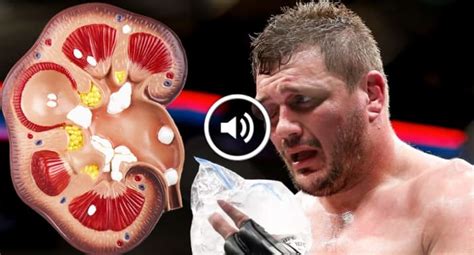 Mitrione Details Procedure To Remove Million Dollar Kidney Stones