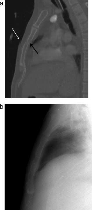 Sternal Fracture In The Emergency Department Diagnostic Value Of