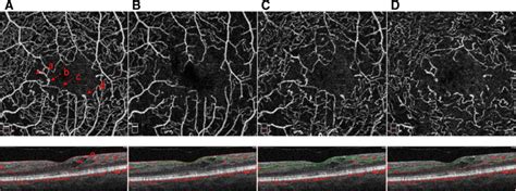 Octa Of Diabetic Macular Edema Octa Of A Full Retina B Download Scientific Diagram