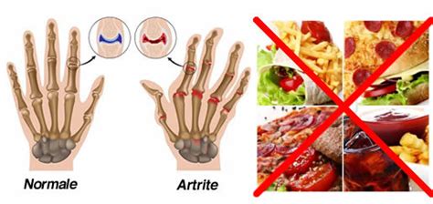 Alimentos Que Debes Evitar Para Prevenir La Artritis Todos Remedios