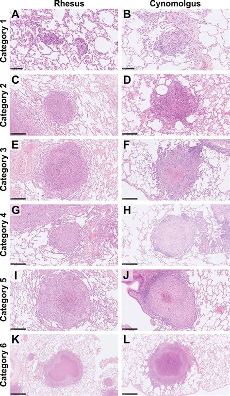 Macrophage Vs Lymphocyte Histology