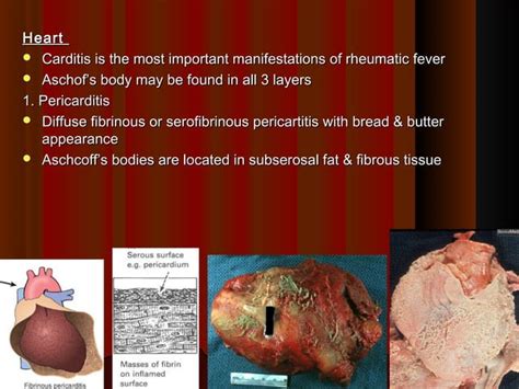 5 Rheumatic Heart Disease Pathology