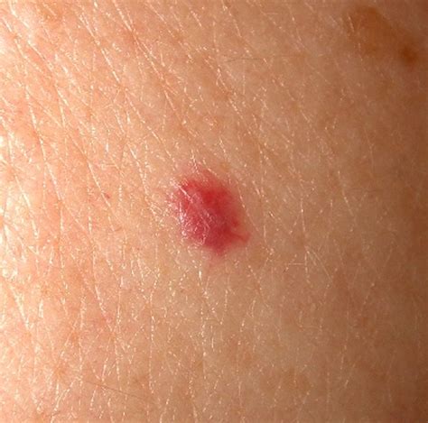 Cherry Angioma | Current Health Advice, Health Blog Articles and Tips