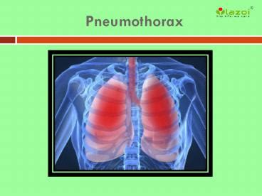 Ppt Pneumothorax Symptoms Causes Diagnoses And Treatment