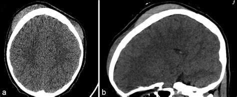 Surgical Neurology International