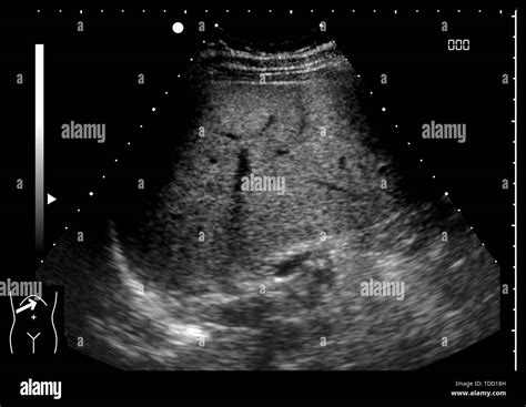 Healthy Liver Ultrasound Scan Stock Photo Alamy