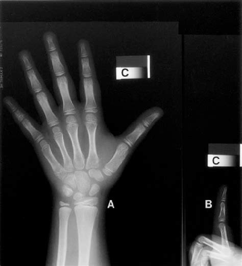 An Example Of The X Ray Images Used In This Study A Posteroanterior