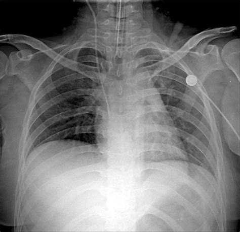 Pulmonary Edema Chest X Ray