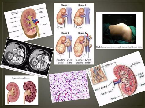 Carcinoma de células renales bilateral PPT