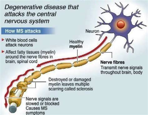 Multiple Sclerosis and Exercise - Pivotal Physio