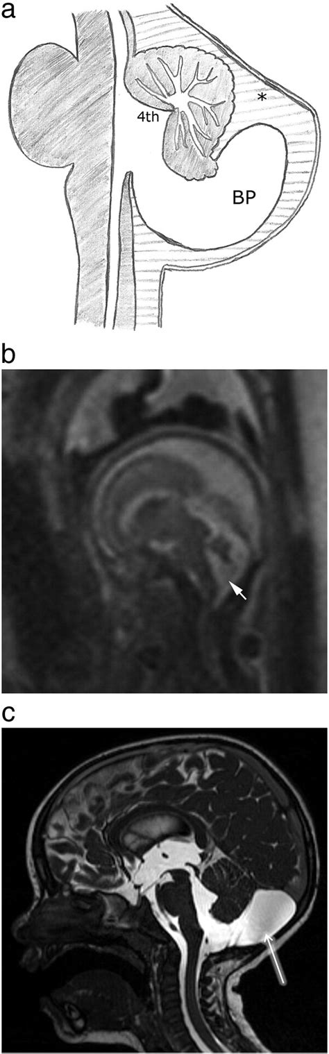 Diagnostic Imaging Of Posterior Fossa Anomalies In The Fetus And