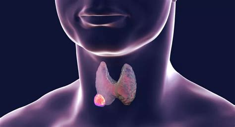 Cáncer de tiroides qué es gravedad tipos y síntomas Salud