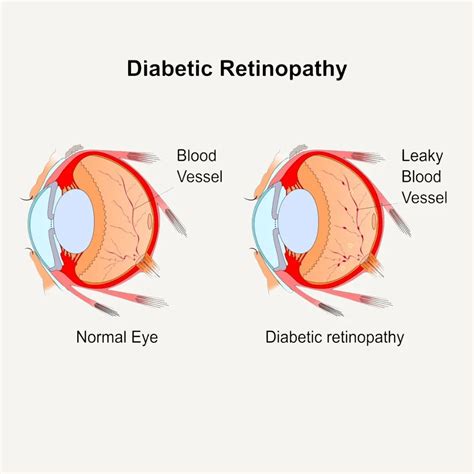 Diabetic Eye Diseases | Optician in Monroe, WA | Optometrist