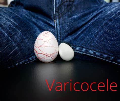 Sintomi Varicocele