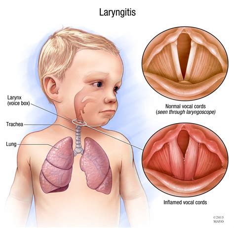 What Is Laryngitis Mayo Clinic News Network