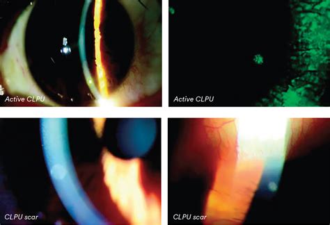 Corneal Ulcer Contact Lens