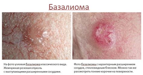 Причини розвитку та види раку шкіри - Estet-Portal