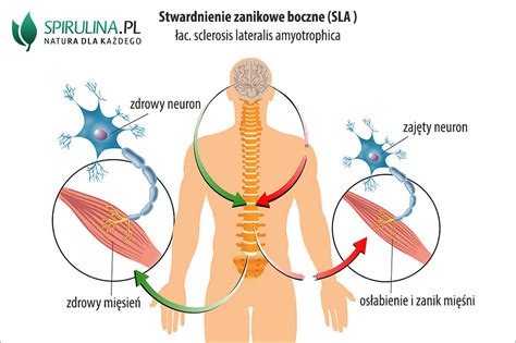 Stwardnienie Zanikowe Boczne Algi Spirulina I Chlorella