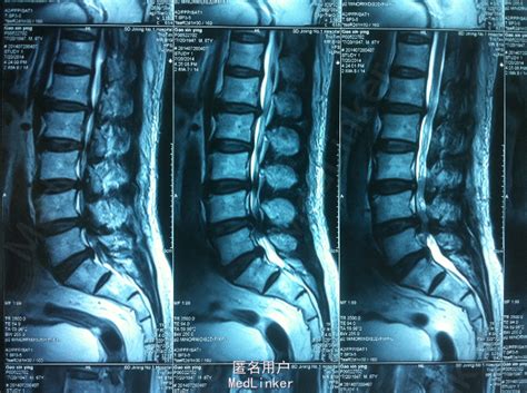 腰椎间盘突出 后路切除内固定术 医联