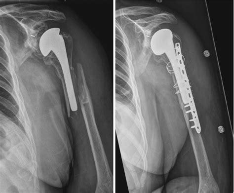 Total Shoulder Arthroplasty: Epidemiology and Causes | Musculoskeletal Key