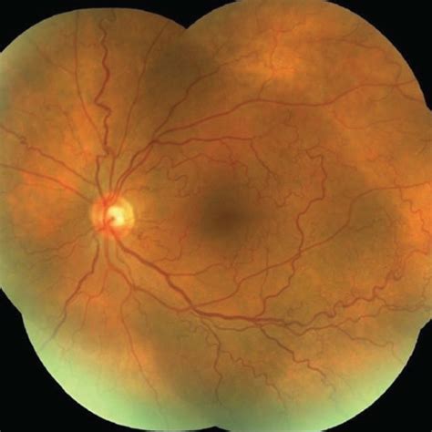 Colour Fundus Photograph Of The Right A And The Left B Eyes Fundus