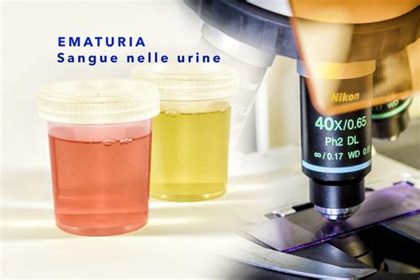 Ematuria Sangue Nelle Urine Dr Andrea Militello Urologo Andrologo