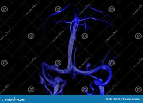 Arteriography Of Left Cervical Carotid Artery Occlusion Stock Image