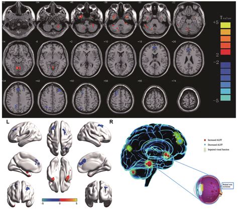 Significant Differences In Spontaneous Brain Activity Between The