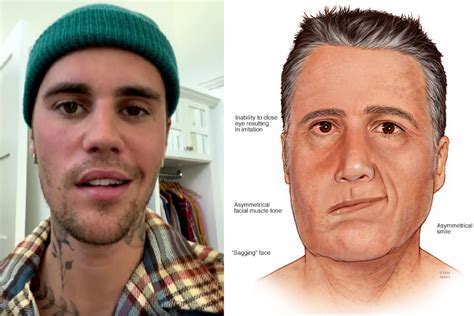 ¿qué Es El Síndrome De Ramsay Hunt El Diagnóstico De Justin Bieber