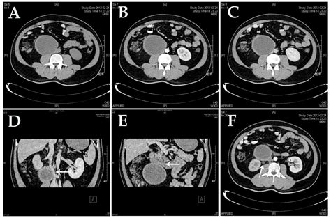 Adult Primary Retroperitoneal Cavernous Hemangioma A Case Report