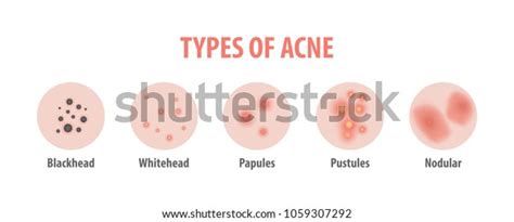 Types Acne Diagram Illustration Vector On Stock Vector Royalty Free