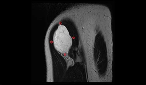 Soft Tissue Sarcoma Mri Radiology Article On Soft Tissue Sarcoma Mri