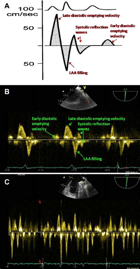 E Left Atrial Appendage Laa Flow Pattern A Schematic Diagram