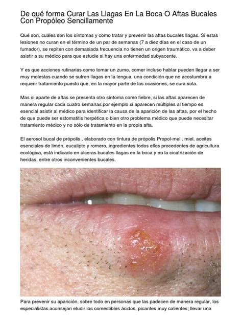 De Qué Forma Curar Las Llagas En La Boca O Aftas Bucales Con Propóleo