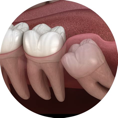 Wisdom Teeth Surgery Teo Dental Sri Petaling