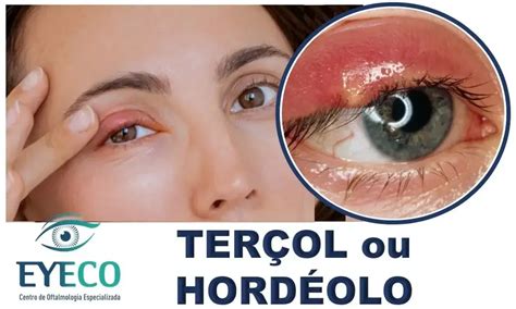 O Que Causa Tercol No Olho - Terçol ou Hordéolo? Descubra as Causas, Sintomas e o Tratamento Mais ...