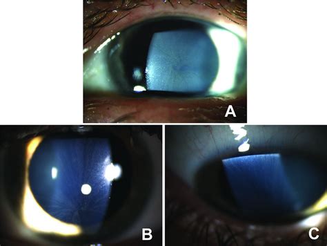 Conjunctival Lymphangiectasia Associated With Classic Fabry Disease British Journal Of