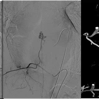 Preoperative Double Injection Microcatheter Angiography Showing A