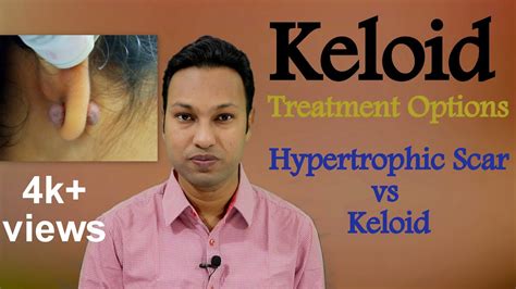 Keloid Treatment Options Hypertrophic Scar Vs Keloid Youtube