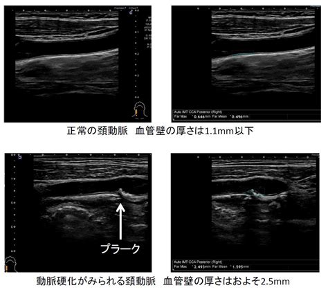 頚部超音波検査（頚動脈エコー） 医療法人 木村医院