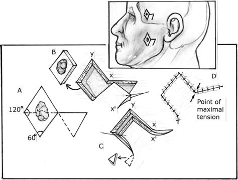 Concepts In Local Flap Design And Classification Operative Techniques