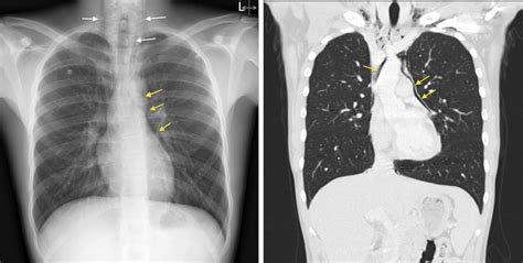 Pneumomediastinum Cxr And Ct Radiology At St Vincents University Hospital