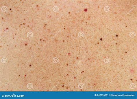 Moles And Birthmark On Human Skin Stock Image Image Of Laser Back