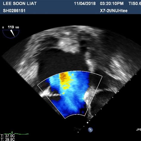 Preoperative Transesophageal Echocardiogram Showing Color Flow Across