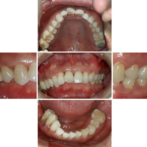 Post Orthodontic Intraoral Views A Maxillary Occlusal View B